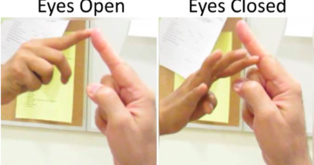 Los pacientes con una mutación en el gen PIEZO2 no aciertan a juntar sus dedos índices con los ojos cerrados. Imagen: Laboratorio Bonnemann. Fuente: NIH/NINDS.