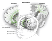 Cadenas migratorias de neuronas jóvenes en el lóbulo frontal del cerebro de lactantes. Fuente: 'Science'.