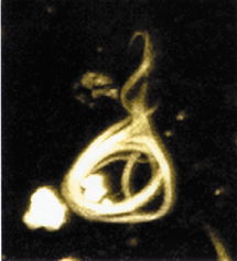 Imagen microscópica de un ovillo neurofibrilar, conformado por proteínas tau hiperfosforiladas. Fuente: Wikimedia Commons.