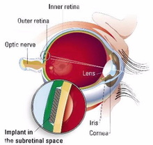 Imagen de implante subretinal del Vision. Fuente: Vision Loss Center.