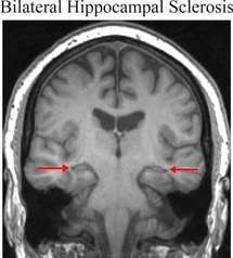 Imagen del cerebro de un paciente con esclerosis bilateral del hipocampo. El hipocampo está indicado por las flechas y es más pequeño que un hipocampo normal. Fuente: UCL.