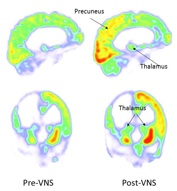 Cambio de la actividad cerebral 3 meses después del VNS (antes, izquierda; después, derecha). CREDIT Corazzol et al.