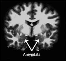 La amígdala, que forma parte de la región temporal media del cerebro y está relacionada con el procesamiento de las emociones, era mayor en los individuos escrupulosos y menor en los neuróticos. Fuente: Washington University.