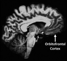 La corteza orbitofrontal, que forma parte de la región prefrontal y está implicada en los procesamientos socio/emocionales, mostró asociaciones similares con la personaldiad. Fuente: Universidad de Washington.
