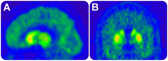 Imágenes de la radioacticidad regional en el cerebro, durante la investigación. PLosOne. Imágenes de la radioacticidad regional en el cerebro, durante la investigación. PLosOne.