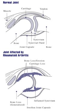 Ilustración de una articulación afectada por Artritis reumatoide. Wikipedia
