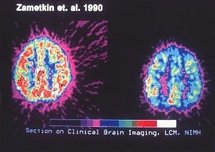 Actividad metabólica cerebral en personas sin TDAH (izquierda) y con él (derecha). Fuente: Wikimedia Commons.
