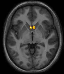 El alivio del dolor inducido por el amor ha sido asociado a la activación en estructuras cerebrales profundas, como el núcleo accumbens (en color en la imagen). Fuente: Universidad de Stanford.