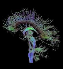 Reconstrucción tractográfica de las conexiones neurales a través de imagen por resonancia magnética. Fuente: Wikimedia Commons.