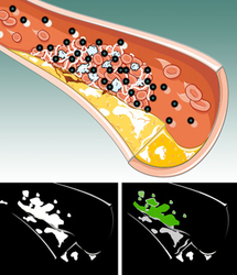 El CT tradicional (abajo a la izquierda) no muestra diferencias entre el coágulo de sangre y el calcio de la placa. En cambio el CT espectral (inferior derecha) se puede apreciar las nanopartículas dirigidas a la fibrina (en verde). Foto: WUSTl