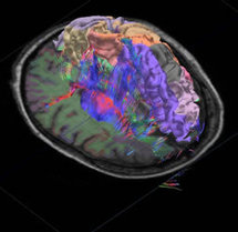 Tracto de fibras nerviosas en 3D, segmentación cortical e imagen IRM del cerebro humano. Fuente: Allen Institute for Brain Research.