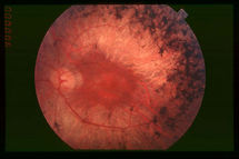 Fondo de ojo de un paciente afectado con retinosis pigmentaria. Obsérvese la acumulación de pigmento en la periferia de la retina. Fuente: Wikimedia Commons.