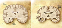 Comparación entre un cerebro normal y un cerebro afectado de Alzheimer. Fuente: Wikimedia Commons. Comparación entre un cerebro normal y un cerebro afectado de Alzheimer. Fuente: Wikimedia Commons.