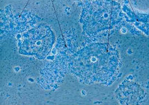 Micrografía de vaginosis bacterial - células escamosas del cérvix cubiertas con la bacteria Gardnerella vaginalis (flechas). Fuente: Wikimedia Commons.