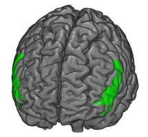 Esquema de las redes neuronales asociadas con los síntomas del Trastorno por Déficit de Atención con Hiperactividad (TDAH). Imagen: Robert Whelan/ Hugh Garavan.
