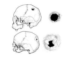 Dibujo de los dos cráneos y su trepanación (arriba mujer, debajo hombre). Imagen: Esther Gómez López. Dibujo de los dos cráneos y su trepanación (arriba mujer, debajo hombre). Imagen: Esther Gómez López.