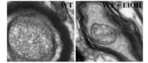 La parte izquierda de la imagen muestra un cerebro normal; la parte derecha un cerebro afectado por el consumo crónico de alcohol en el que se observa el daño producido por la ruptura de las vainas de mielina. Fuente: CIPF.