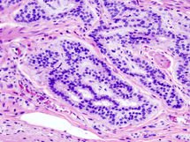 Imagen histopatológica de carcinoide de colon teñido con hematoxilina y eosina. Wikipedia.