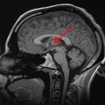 La flecha señala la ubicación del tálamo en el cerebro. Fuente: Wikimedia Commons.