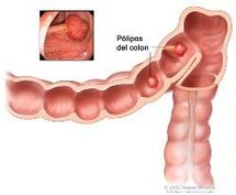 Pólipos en el colon son tumores que pueden convertirse en cáncer de colon. Pueden ser planos o tener tallos, como en la imagen. Imagen: Teresa Winslow. Fuente: NCI.