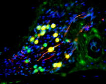Una neurona auditiva derivada de células madre repuebla la cóclea de un jerbo sordo. Las células humanas son las coloreadas en verde. El color rojo es un marcador de diferenciación neuronal. Imagen: Marcelo Rivolta, Universidad of Sheffield. Fuente: SINC.