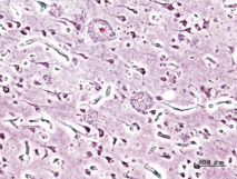 Imagen histopatológica de placas seniles vista en la corteza cerebral de un paciente con la enfermedad de Alzheimer. Fuente: Wikimedia Commons.