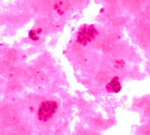 Metástasis de cáncer de mama en líquido pleural. Imagen: Euthman. Fuente: Flickr.