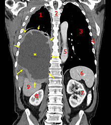 Un TAC coronal mostrando un cáncer en la cavidad pulmonar. Fuente: Wikimedia Commons. Un TAC coronal mostrando un cáncer en la cavidad pulmonar. Fuente: Wikimedia Commons.