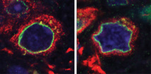 La célula madre neural de la derecha (con mutación LRRK2), de un paciente de Parkinson fallecido, tiene el núcleo deformado. La célula de la izquierda es normal. Imagen: Mercè Martí y Juan Carlos Izpisua.