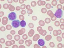 Sangre periférica que muestra una leucemia linfática crónica. Imagen: VashiDonsk. Fuente: Wikipedia.