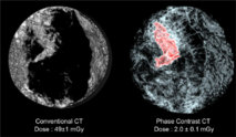 Comparación entre un escáner convencional de mama (izquierda) con uno obtenido con el nuevo método. Fuente: ESRF-LMU/Brun.
