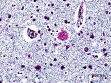 Comienzo de Alzhéimer en el cerebro. Imagen: KGH. Fuente: WIkipedia.