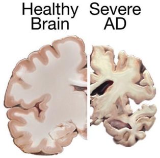 Diferencia entre un cerebro normal y uno muy dañado por el alzhéimer. Fuente: Wikimedia Commons.