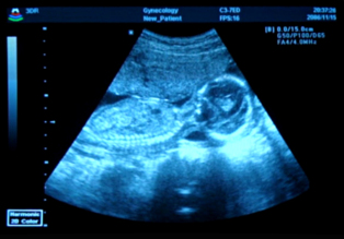Sonografía de un feto. Imagen: Hamed Saber. Fuente: Flickr.