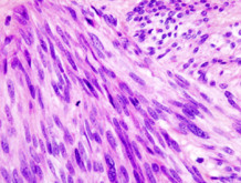 Imagen histopatológica de tumor del estroma gastrointestinal de estómago. Imagen: KGH. Fuente: Wikimedia Commons.