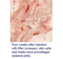 Solo cuatro semanas después de las inyecciones con relleno cosmético (en cruces), las células de la piel ya producían más colágeno.  Fuente: UM.