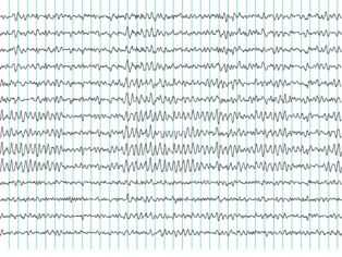 Un electroencefalograma. Imagen: Bemoeial2. Fuente: Wikipedia.