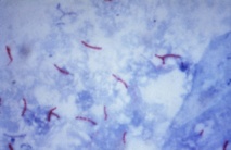 Imagen de la bacteria de la tuberculosis obtenida con la tinción de  Ziehl-Neelsen. Imagen: George P. Kubica. Fuente: Wikipedia.