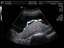 Imagen de ultrasonido de una placenta humana a las 20 semanas de gestación. Imagen: Wolfgang Moroder. Fuente: Wikimedia Commons.