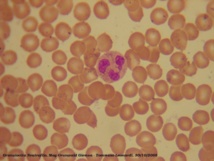 Neutrófilo rodeado de glóbulos rojos. Imagen: Tommaso Leonardi. Fuente: Wikipedia.