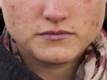 Chica con acné moderado. Fuente: UGR.
