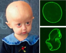 La progeria produce envejecimiento prematuro. Fuente: Wikipedia. La progeria produce envejecimiento prematuro. Fuente: Wikipedia.