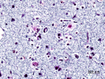 Corte de tejido cerebral de un enfermo de alzhéimer. Imagen: KGH. Fuente: Wikipedia.