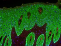 Sección de piel hiperproliferativa. Fuente: CIC.