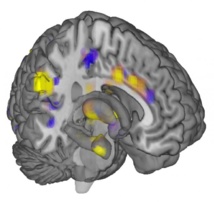 Huella neurológica del dolor físico identificada en el presente estudio. Imagen: Tor Wager. Fuente: Universidad de Colorado en Boulder.
