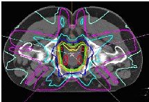 El sistema marca la zona a tratar en la próstata