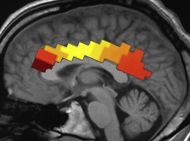 La actividad neuronal en diversas partes del cerebro a la vez es un síntoma de conciencia, según las teorías neurológicas. Detectar dicha actividad resulta clave, por tanto, para establecer el grado de conciencia de cada paciente. Imagen: Flickr.