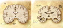 A la izquierda, un cerebro normal. A la derecha, uno con Alzheimer. Fuente: Wikipedia.