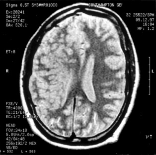 Cerebro de un paciente que parece haber perdido ambas copias del gen BRCA1. Fuente: BMJ. Cerebro de un paciente que parece haber perdido ambas copias del gen BRCA1. Fuente: BMJ.