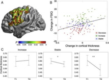 Correlación entre el CI y el grosor de la corteza cerebral. Fuente: NeuroImage/UPF. Correlación entre el CI y el grosor de la corteza cerebral. Fuente: NeuroImage/UPF.